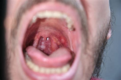 Throat Ulcers Stock Photos, Pictures & Royalty-Free Images - iStock