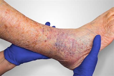 Wound Assessment and Documentation (Microlearning) - Medline