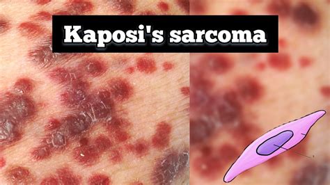 Kaposi's sarcoma pathology | Kaposi's sarcoma lecture { Quick revision ...