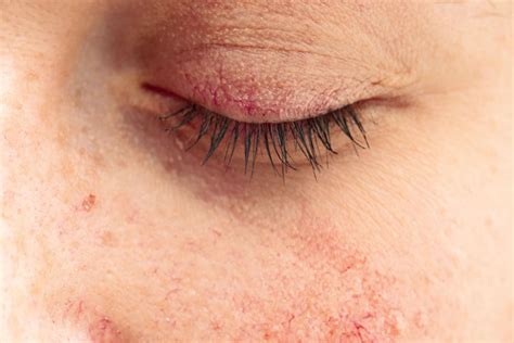 Ocular Rosacea: Symptoms, Causes & Treatment | MyVision.org