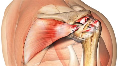 Rotator Cuff Injury Exercise Video