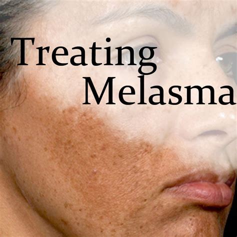 Melasma Treatment - laser treatment for skincare | Dr Sin Yong