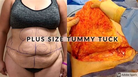 Plus Size Tummy Tuck+ Back Liposuction - Dr Repta Plastic Surgery - YouTube