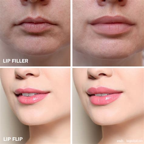 How to Choose between a Lip-Flip and Lip-Fillers - Her Style Code