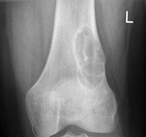 Metaphyseal Fracture Treatment | Metaphyseal Fracture Surgery