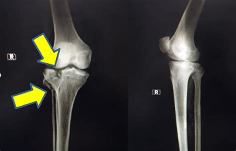 Unusual Good Functional Outcome After Surgical Management of Maluniting Schatzker Type II ...