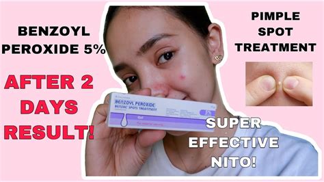 BENZOYL PEROXIDE 5% | AFTER 2 DAYS RESULT | EFFECTIVE BA SA PIMPLES? - YouTube
