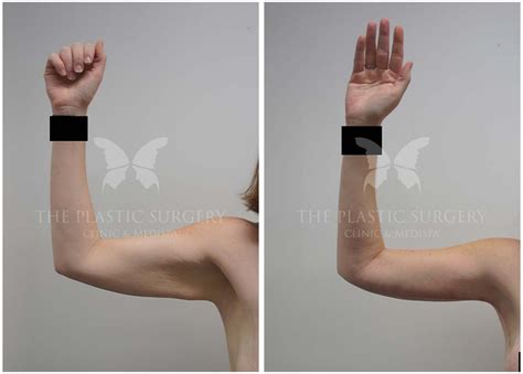 Arm Lift Gallery | Before and Afters | Dr Chaithan Reddy