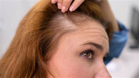 Female Pattern Baldness: Causes, Symptoms, Types, And Treatment ...