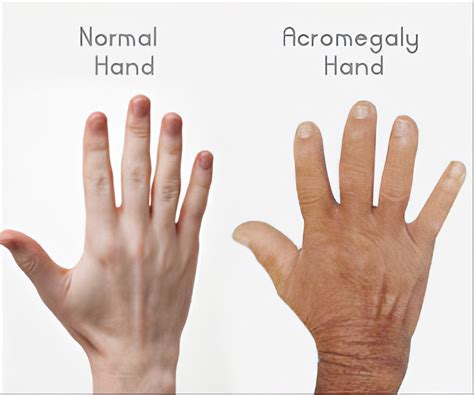 Pituitary Gigantism Vs Acromegaly