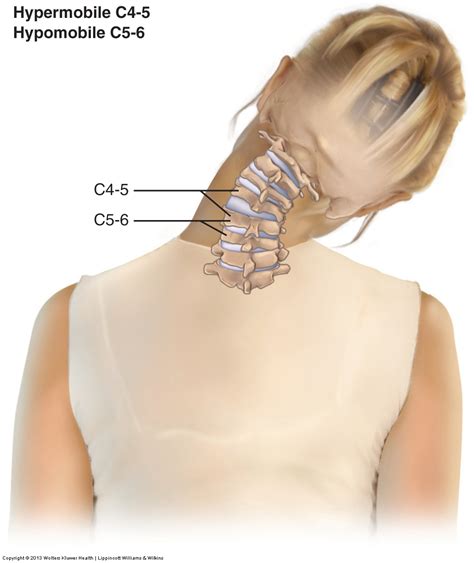 Joint Dysfunction (subluxation, misalignment) of the Cervical Spine