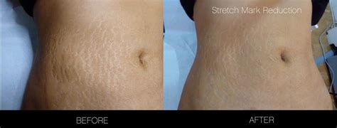 How To Get Rid Of Stretch Marks | Toronto | SpaMedica