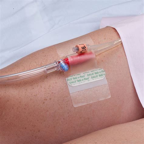 Foley Catheter Nursing Skill Template