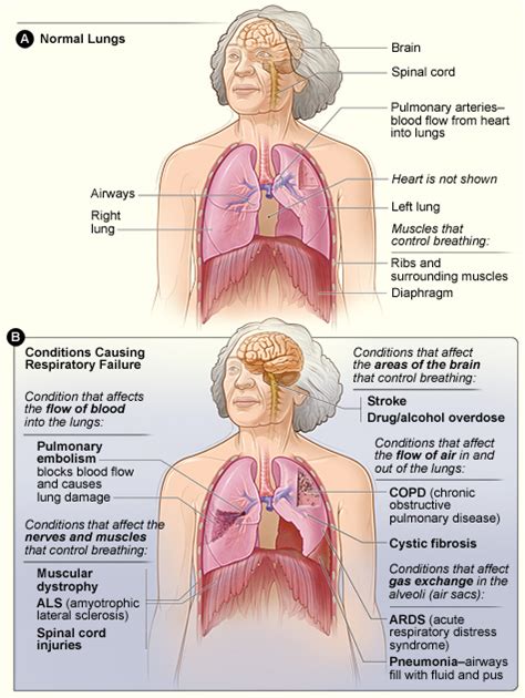 Arterial Blood Gases - Physiopedia