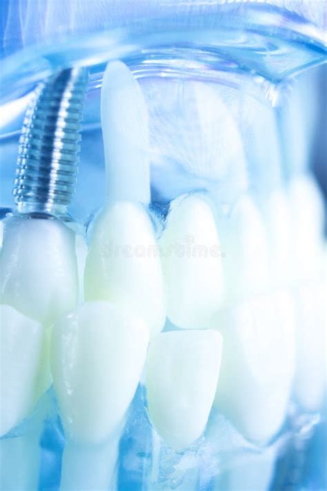 Dental Titanium Tooth Implant Stock Photo - Image of dental, implants: 102047208