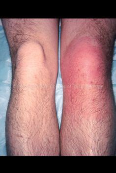 Bursitis of the knee on Pinterest