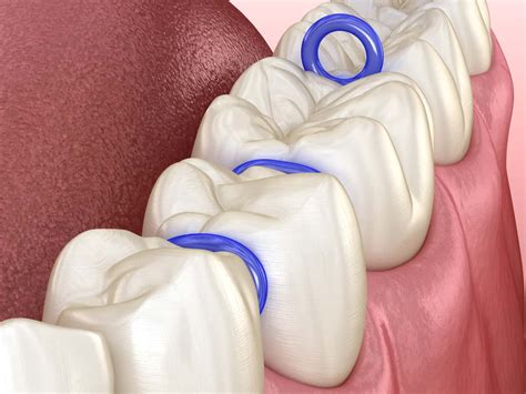 What are Orthodontic Spacers? - ArchWired