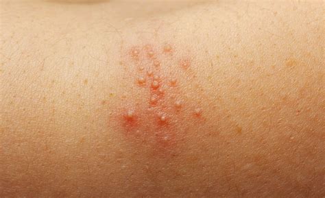 Prickly heat (sweat rash) | Family Health Diary