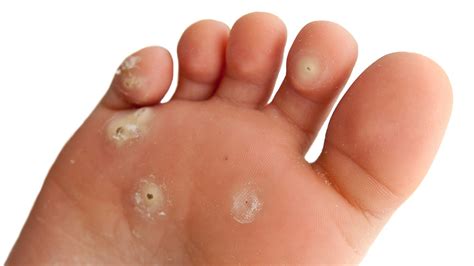 Common Skin Warts Causes, Prevention, and Treatment