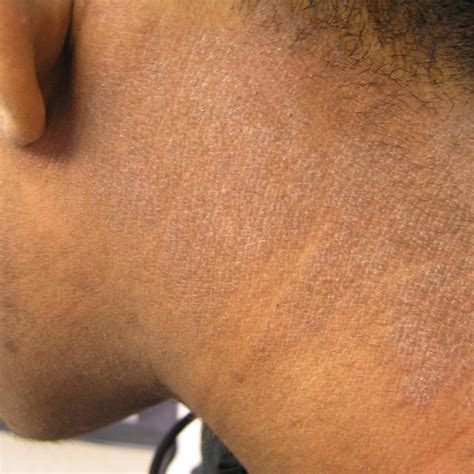 What Does Eczema Look Like?