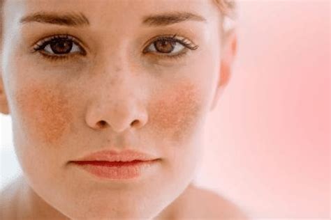 Ácido tranexâmico para melasma | Almanaque da Mulher