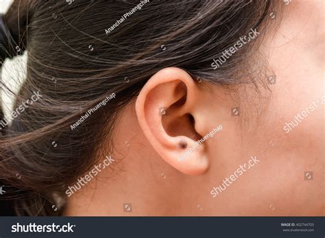 115 Birthmark on ear Images, Stock Photos & Vectors | Shutterstock