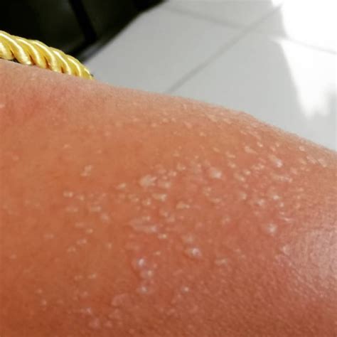 Brown Spots On Skin After Sunburn - BEST GAMES WALKTHROUGH