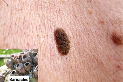 Seborrheic Keratosis (Skin Barnacles): Pictures, Cause, Removal