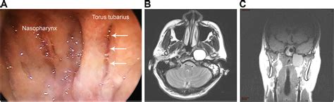 Torus Tubarius Mri