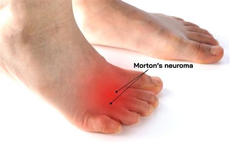 Morton’s Neuroma Surgery in Miami | Luxe Foot Surgery