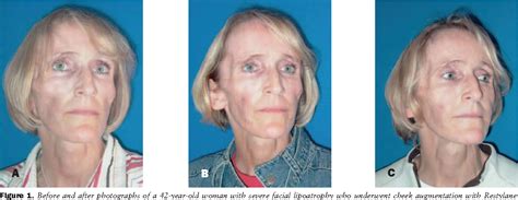 Figure 1 from HIV-related lipodystrophy and facial lipoatrophy: the role of Restylane SubQ in ...