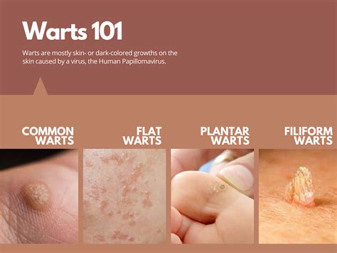 Common Warts Removal