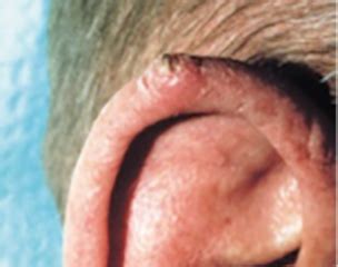 Squamous Cell Carcinoma Ear Pictures - the meta pictures