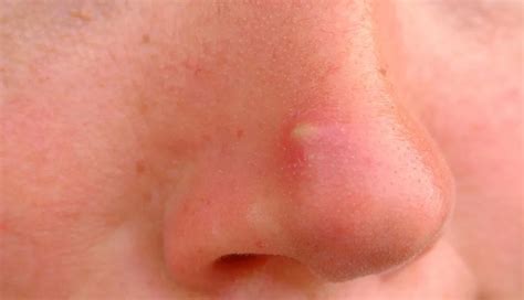 Quick Home Remedies To Help You Get Rid of Nose Acne - lifeberrys.com