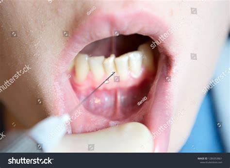 Injection Dental Needle Images: Browse 2,505 Stock Photos & Vectors ...