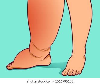 Swollen Feet Beforeafter Vector Illustration Stock Vector (Royalty Free) 1516795133 | Shutterstock