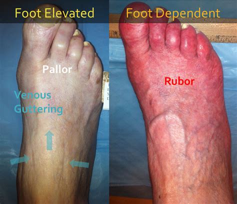 Klinisk Evaluering Av Foten For Perifer Arteriell Sykdom | Michael Cumming, MD, MBA | be settled