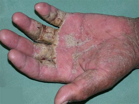 Scabies - Signs, Symptoms, OTC Treatment & Home Remedies