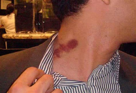 How Long Do Hickeys Last, Hickey Pictures, Definition, are they Bad, Hurting & Cancerous?