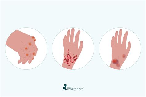 Rheumatoid Arthritis and Skin Problems: What You Need to Know