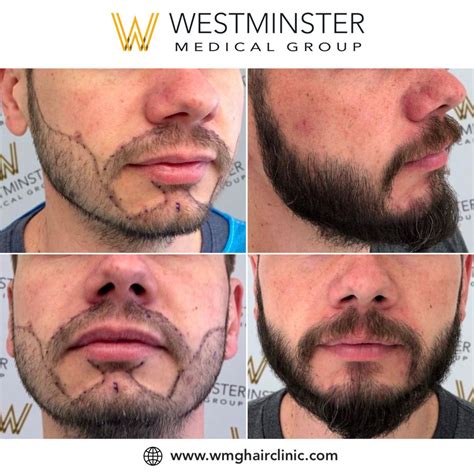 Beard Transplant - Westminster Medical Group in 2023 | Facial hair transplant, Beard transplant ...