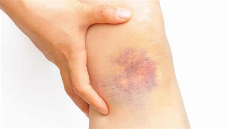 Bruise - Causes, Diagnosis, Treatment, Home Remedy and Healing Time
