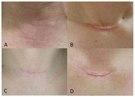 Scar Tissue After Thyroid Surgery