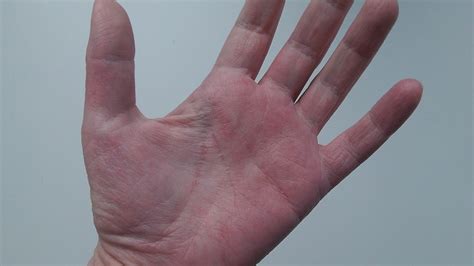 itchy rash on palms of hands - pictures, photos