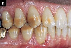 Direct Composite Restorations to Mask Intrinsic Staining: An Eighteen-Year Follow-Up - Dentistry ...