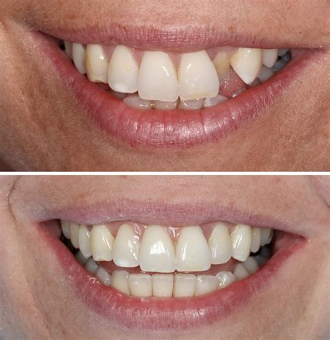 Invisalign before and after 2 - Beyond Dental