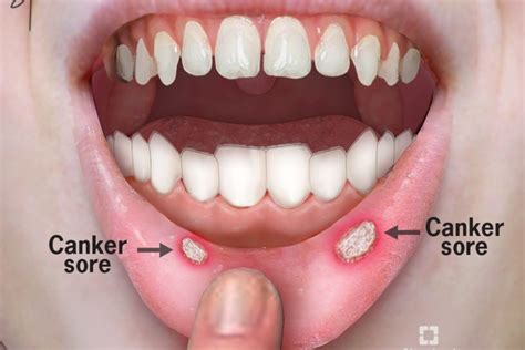 Difference Between Canker Sores And Mouth Ulcers | Images and Photos finder