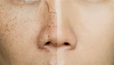 Pigmentation on Face - Causes, Types and Treatment: Beauty Tips By Nim