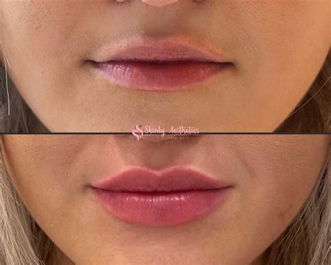 Lip Filler Injections - Benefits, Costs, Results & Procedure Steps