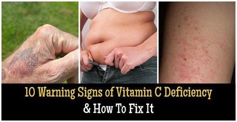 10 Warning Signs of Vitamin C Deficiency & How To Fix It | Vitamin c benefits, Vitamin c, Vitamins